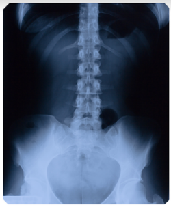 Spinal cord injury claims