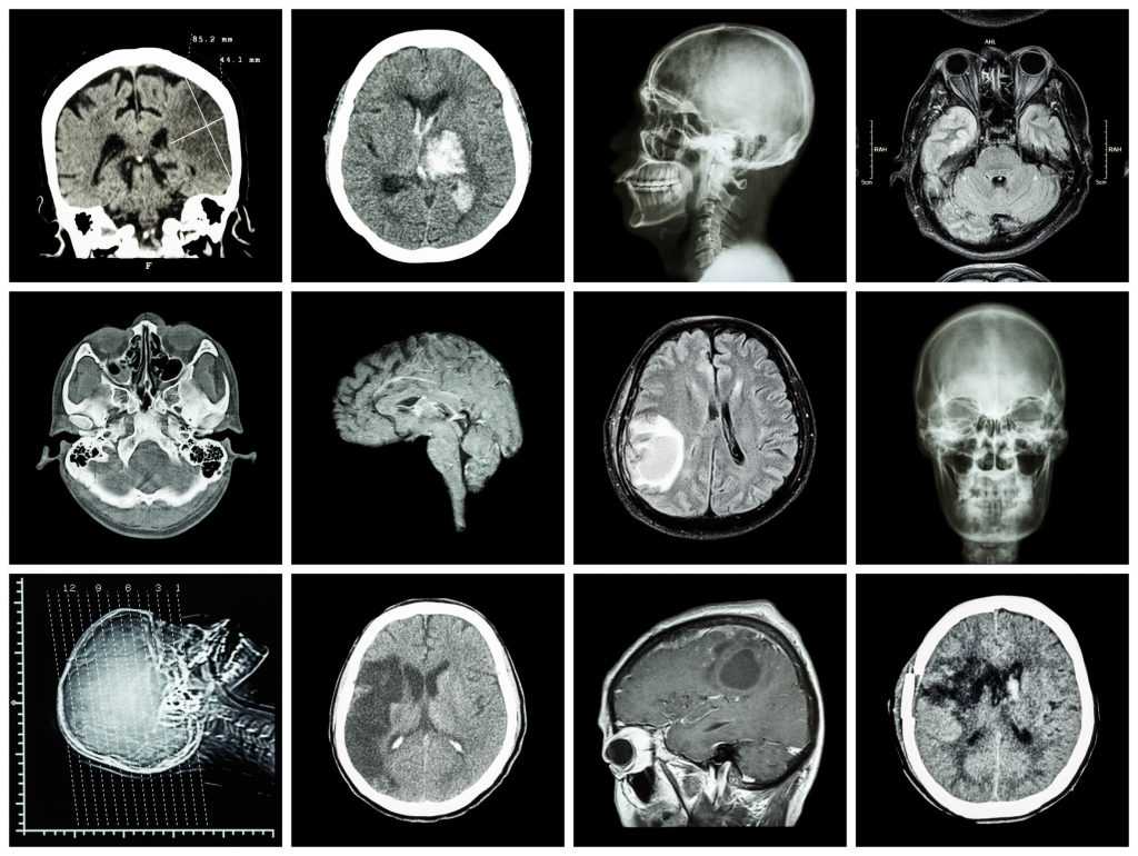Images for use in Brain Injury Lawsuits