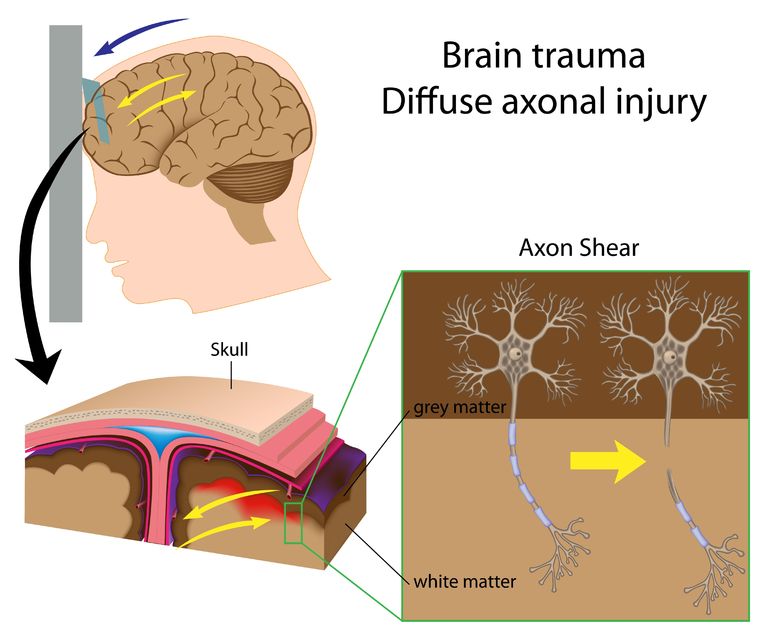 fire qualifications safety Injury: Diffuse What a is Axonal Injury Brain