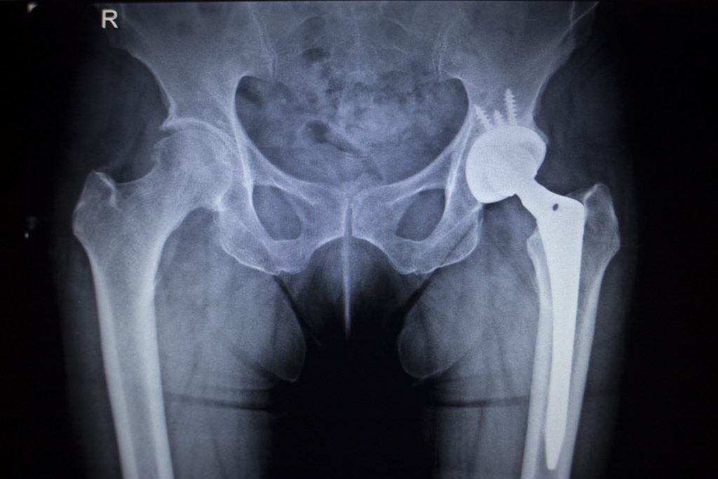 Pelvis Injury Claims