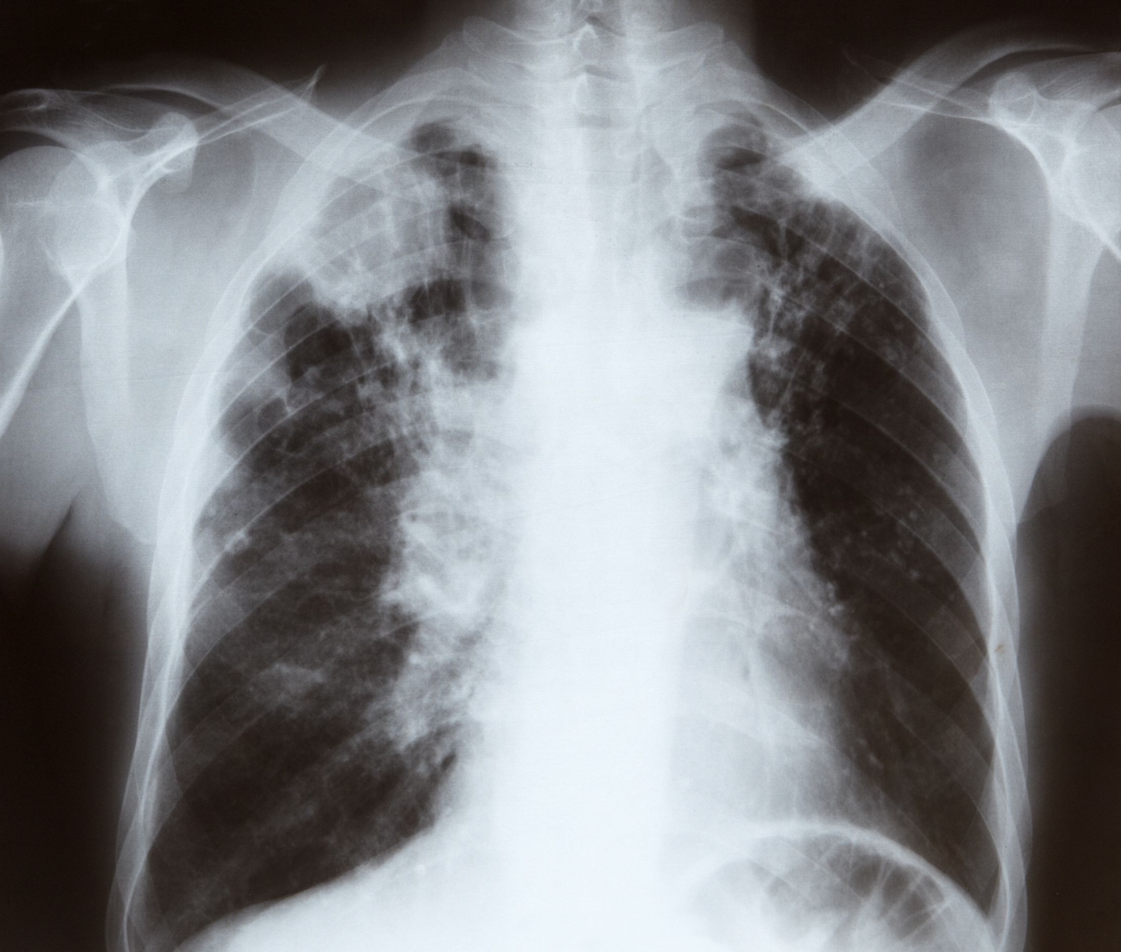 Lung Xray